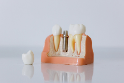 インプラントのメリット